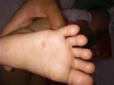 嬰兒肢端膿皰病腳底一個半球形水皰圖 嬰兒肢端膿皰病腳底一個半球形水皰圖