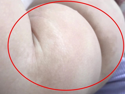 咖啡斑大腿上有不規則的淺咖啡色斑圖 咖啡斑大腿上有不規則的淺咖啡色斑圖