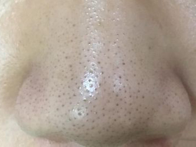 黑頭鼻子上有密集黑點且有顆粒感圖 黑頭鼻子上有密集黑點且有顆粒感圖