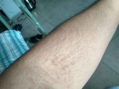 網狀肢端色素沉著胳膊長褐色的斑圖 網狀肢端色素沉著胳膊長褐色的斑圖