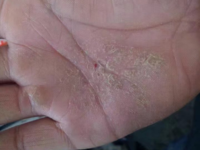 手部濕疹手掌出現黃色皮屑及血痂圖
