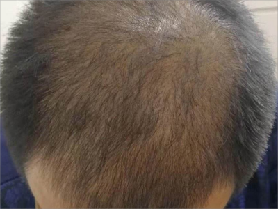 男性型脫髮頭頂頭髮稀疏發黃圖