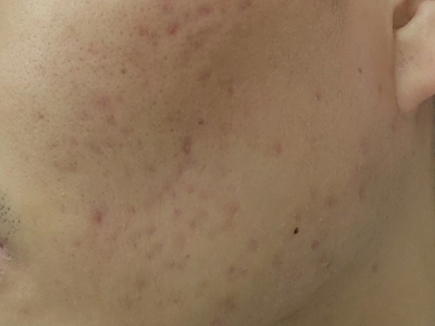 萎縮性瘢痕面部長了好多小坑圖