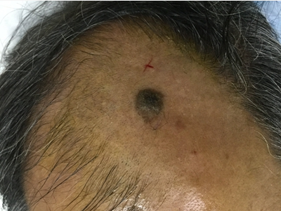 光線性角化病頭皮有一個斑圖 光線性角化病頭皮有一個斑圖