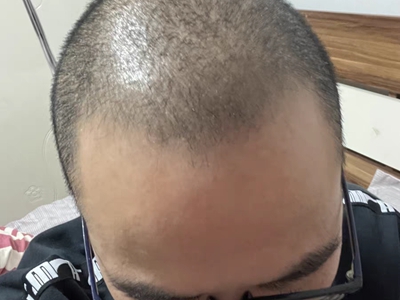 雄激素性脫髮頭頂頭髮稀疏額頭變寬圖 雄激素性脫髮頭頂頭髮稀疏額頭變寬圖