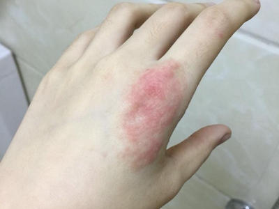 手部濕疹手背一片不規則紅斑圖