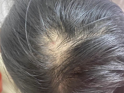 女性型脫髮頭頂中間禿了一塊圖