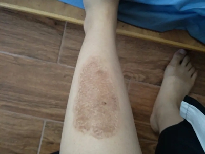 咖啡斑小腿前面有一大片淺咖啡色斑圖 咖啡斑小腿前面有一大片淺咖啡色斑圖