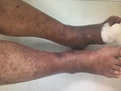 糖尿病性皮膚病小腿和腳皮膚發黑圖 糖尿病性皮膚病小腿和腳皮膚發黑圖
