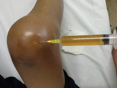 二期梅毒膝蓋腫了個大包圖 二期梅毒膝蓋腫了個大包圖
