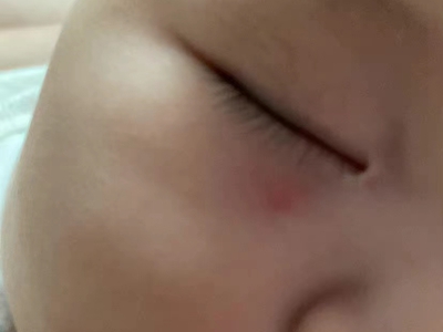 蚊子叮咬寶寶眼睛下邊長小紅疙瘩圖