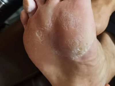窩狀角質松解症腳底有白色糜爛圖 窩狀角質松解症腳底有白色糜爛圖
