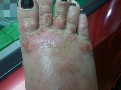 人工性脂膜炎腳部有紅腫糜爛圖 人工性脂膜炎腳部有紅腫糜爛圖