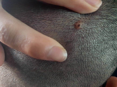 網狀組織細胞肉芽腫頭皮有圓形疙瘩圖 網狀組織細胞肉芽腫頭皮有圓形疙瘩圖