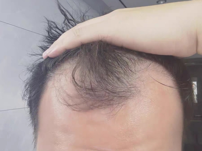 雄激素性脫髮額頭兩側頭髮脫沒了圖