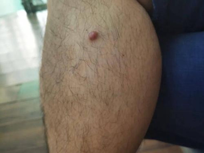 小汗腺汗孔瘤小腿上有一個紅色疙瘩圖 小汗腺汗孔瘤小腿上有一個紅色疙瘩圖