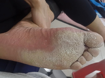窩狀角質松解症腳底發白很多小坑圖