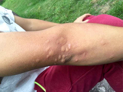 蠓蟲叮咬胳膊上有很多疙瘩圖 蠓蟲叮咬胳膊上有很多疙瘩圖