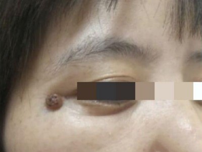 結節型黑色素瘤眼周長褐色凸起物圖
