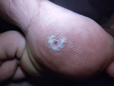 胼胝腳底有個白色硬塊中間破了圖 胼胝腳底有個白色硬塊中間破了圖