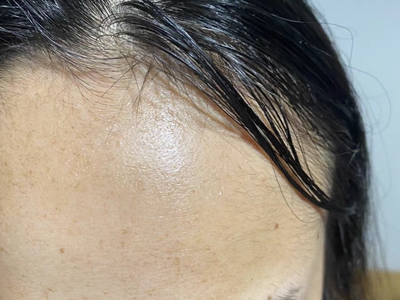 雄激素性脫髮髮際線後移頭髮油膩圖 雄激素性脫髮髮際線後移頭髮油膩圖