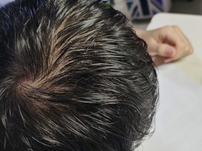 雄激素性脫髮頭頂頭髮稀疏油膩圖