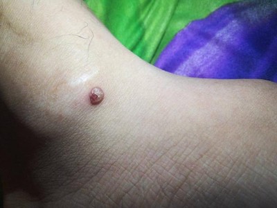 小汗腺汗孔瘤腳踝上長了個小紅疙瘩圖 小汗腺汗孔瘤腳踝上長了個小紅疙瘩圖
