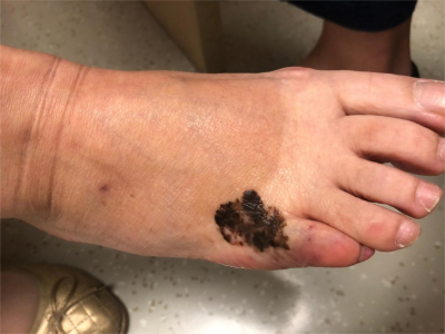 淺表播散型黑色素瘤腳背上長黑斑圖 淺表播散型黑色素瘤腳背上長黑斑圖