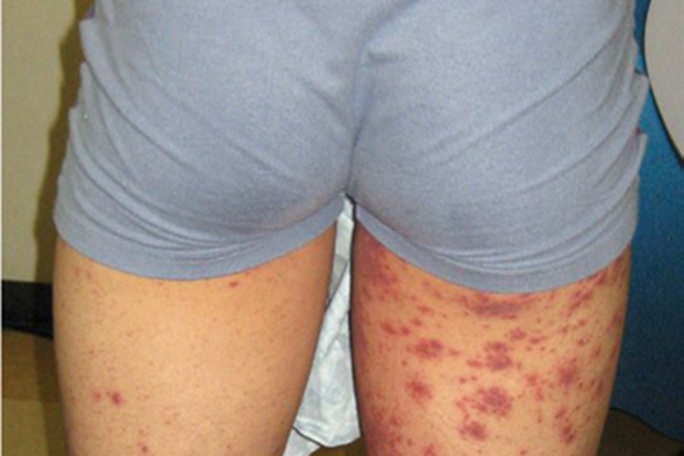 小兒過敏性紫癜大腿後有紫紅色的斑圖