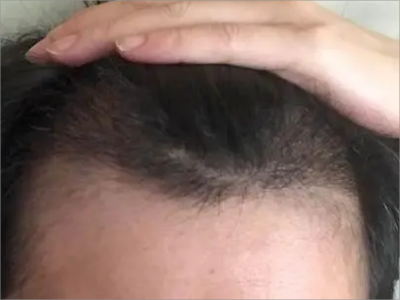 男性型脫髮額頭頭髮稀少髮際線後移圖 男性型脫髮額頭頭髮稀少髮際線後移圖