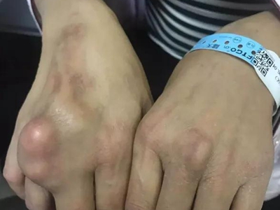 特發性皮膚鈣質沉著症手背有大疙瘩圖 特發性皮膚鈣質沉著症手背有大疙瘩圖