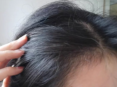 女性型脫髮前額髮際線頭髮稀少圖