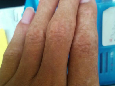 特發性滴狀色素減少症手背密集白斑圖