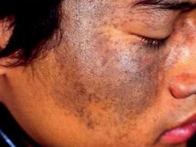 瑞爾黑變病臉上有大面積黑斑圖