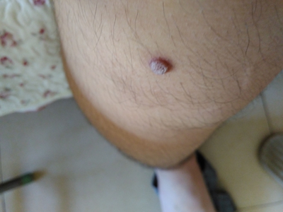 小汗腺汗孔瘤大腿上長了個肉疙瘩圖 小汗腺汗孔瘤大腿上長了個肉疙瘩圖