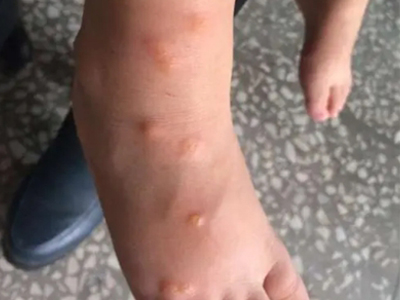蠓蟲叮咬腿上有水皰和疙瘩圖