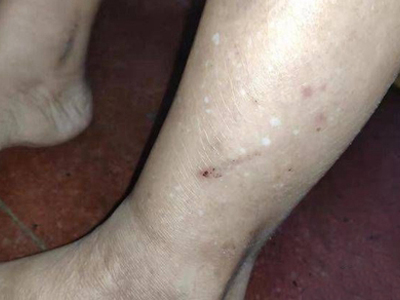 特發性滴狀色素減少症小腿長白斑圖