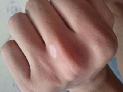 特發性滴狀色素減少症手部長白斑圖