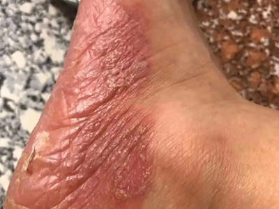皰疹樣膿皰病腳部一側大面積紅斑圖