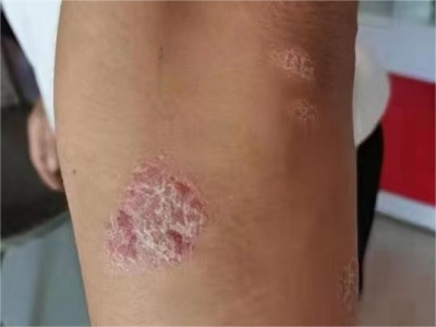 尋常型銀屑病胳膊有凸起的小疙瘩圖
