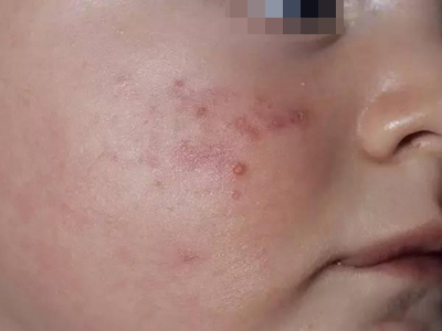 青春期前痤瘡面部起小丘疹圖