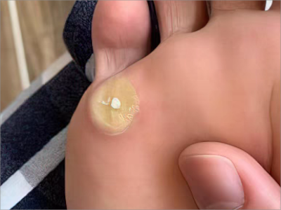 胼胝腳底有一個黃色的圓形硬塊圖