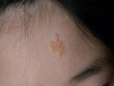 皮脂腺上皮瘤前額長黃斑塊圖