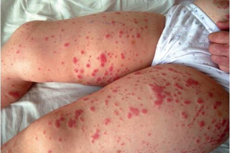 小兒過敏性紫癜大腿上有紅色斑塊圖 小兒過敏性紫癜大腿上有紅色斑塊圖