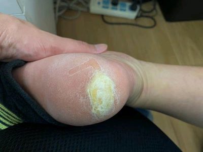 胼胝腳後跟有一大塊粗糙的硬塊圖 胼胝腳後跟有一大塊粗糙的硬塊圖