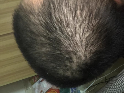 雄激素性脫髮頭頂處頭髮變少圖 雄激素性脫髮頭頂處頭髮變少圖
