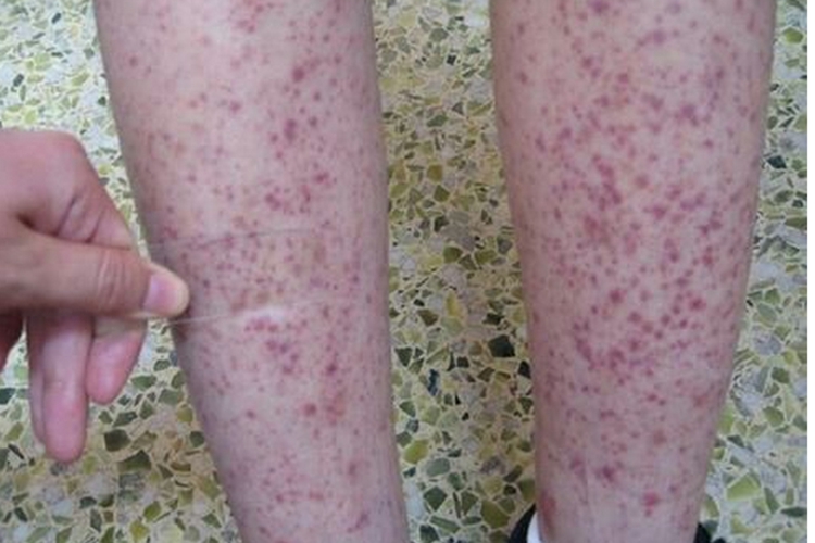 小兒過敏性紫癜雙小腿前有紅斑圖 小兒過敏性紫癜雙小腿前有紅斑圖