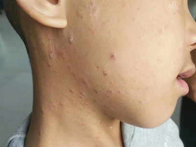 尋常型銀屑病臉側有紅色結節圖 尋常型銀屑病臉側有紅色結節圖