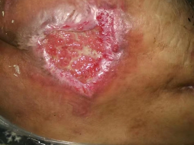 潰瘍期壓瘡臀部化膿圖