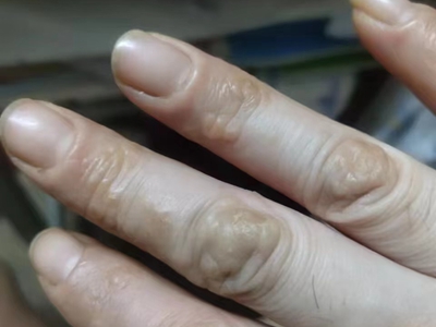 手部濕疹右手手指關節部位有小疙瘩圖 手部濕疹右手手指關節部位有小疙瘩圖